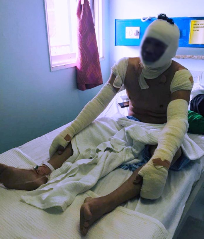 Man suffers second degree burns after gas explosion at Forest Department office in Miri