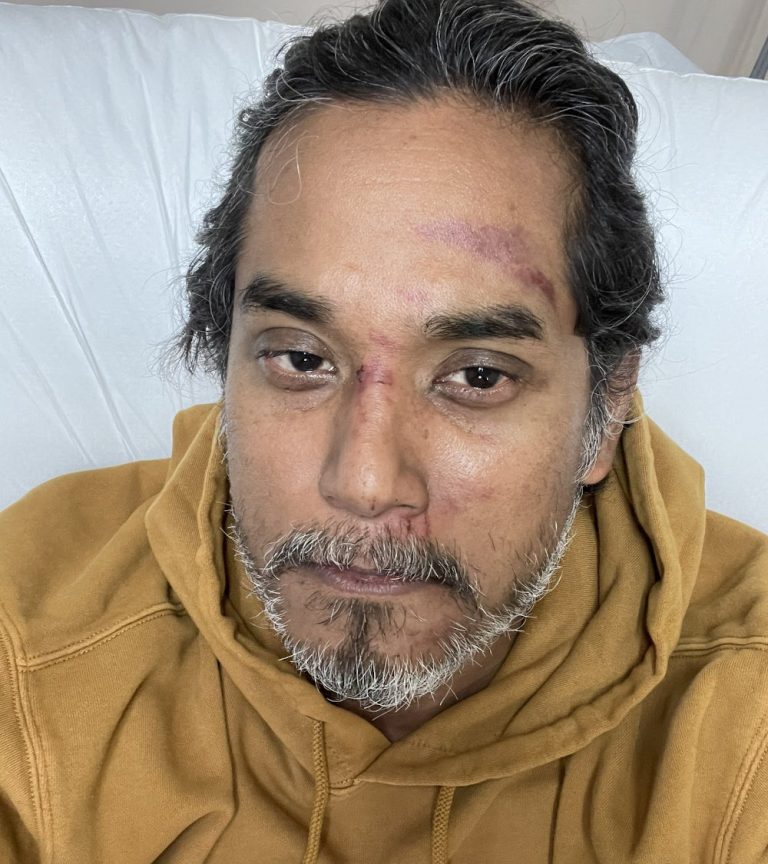 After run-in with pothole while cycling, Khairy tweets ‘2020 keeps giving’